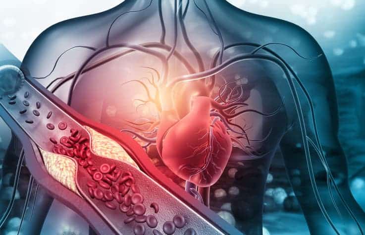 Human heart with blocked arteries illustration