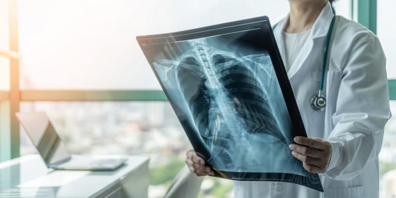 Radiological Chest X-Ray Film