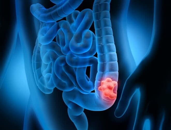 What Is Colorectal Cancer? 1 Colorectal Cancer