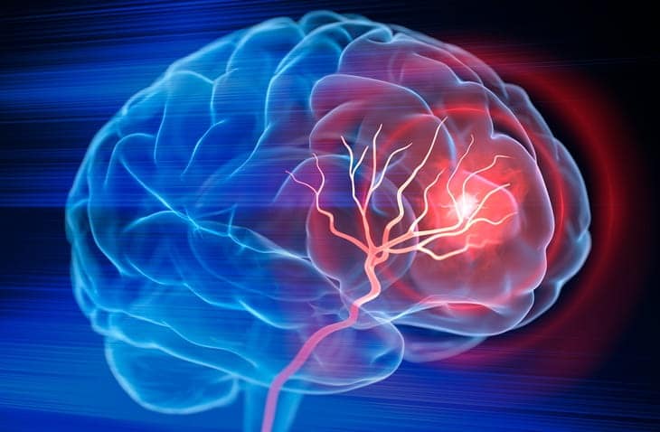 A 3D rendering of a brain with a red area being affected by a stroke. 