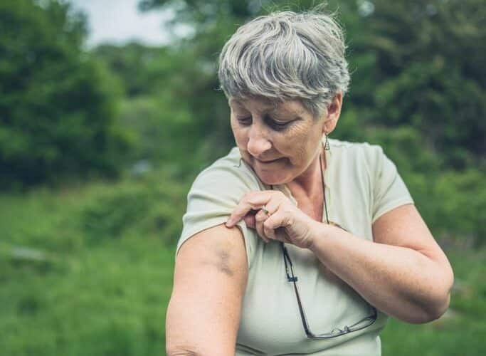 An elderly woman pulling up her sleeve to show a bruise on her arm.