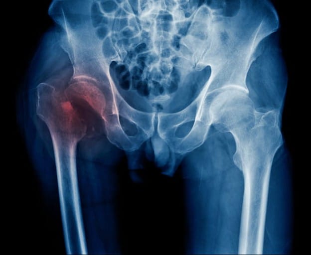 An X-Ray Showing A Broken Hip. 